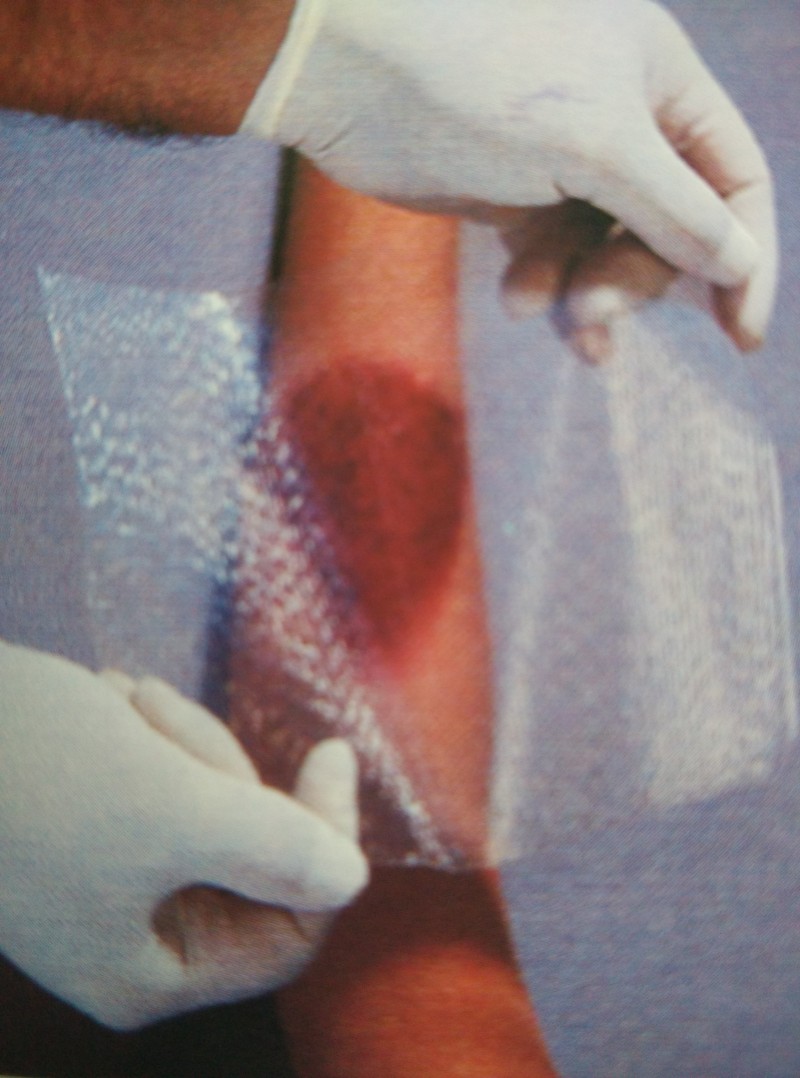 美國(guó)進(jìn)口歐密得燒傷科人工皮膜