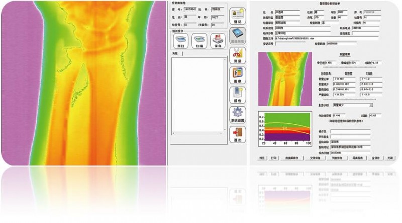 雙能X射線骨密度儀AKDX-09W-I