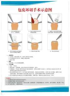 一次性使用包皮吻合器包