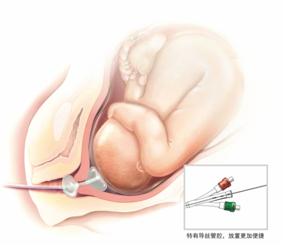 一次性使用子宮頸擴(kuò)張球囊導(dǎo)管