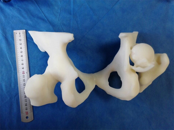 骨科新技術(shù)-3D打印手術(shù)規(guī)劃模型