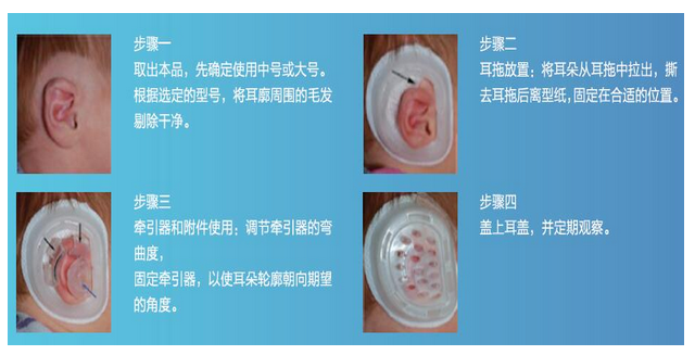 （靚耳）小兒耳廓矯形器