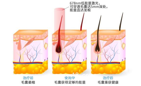 “艾博拉”半導(dǎo)體激光生發(fā)儀、全國(guó)招商代理、加盟