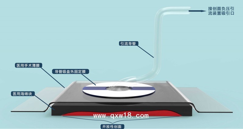 負(fù)壓封閉引流護(hù)創(chuàng)材料