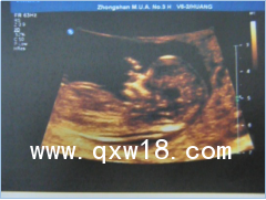 消毒、殺菌的消毒超聲耦合劑