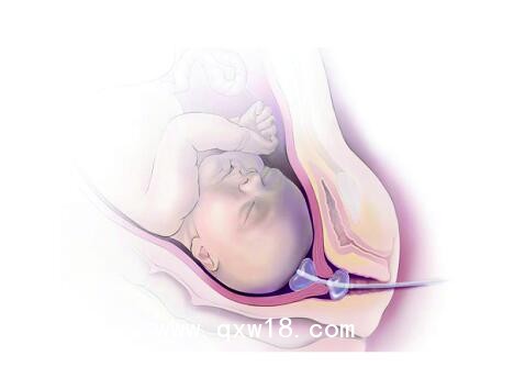 維力醫(yī)療的一次性使用子宮頸擴(kuò)張球囊導(dǎo)管