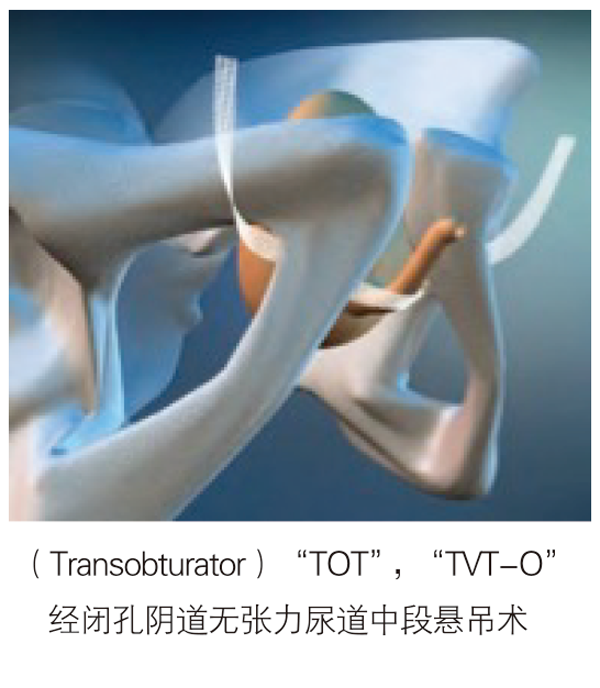 德國PVDF材質(zhì)尿失禁吊帶-SIS/SIS direct