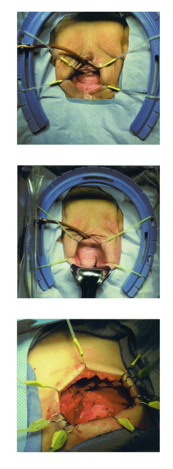 手術(shù)擴(kuò)張器 牽開器 一次性切口固定切開器