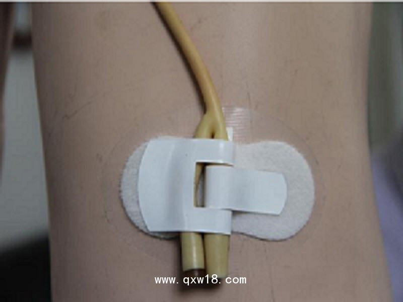 一次性導(dǎo)管固定裝置（導(dǎo)尿管固定裝置）