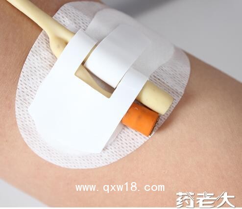 導(dǎo)管固定器