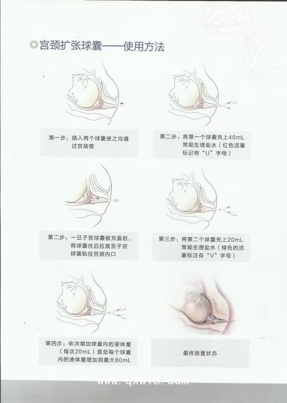 一次性子宮頸球囊導管引產包