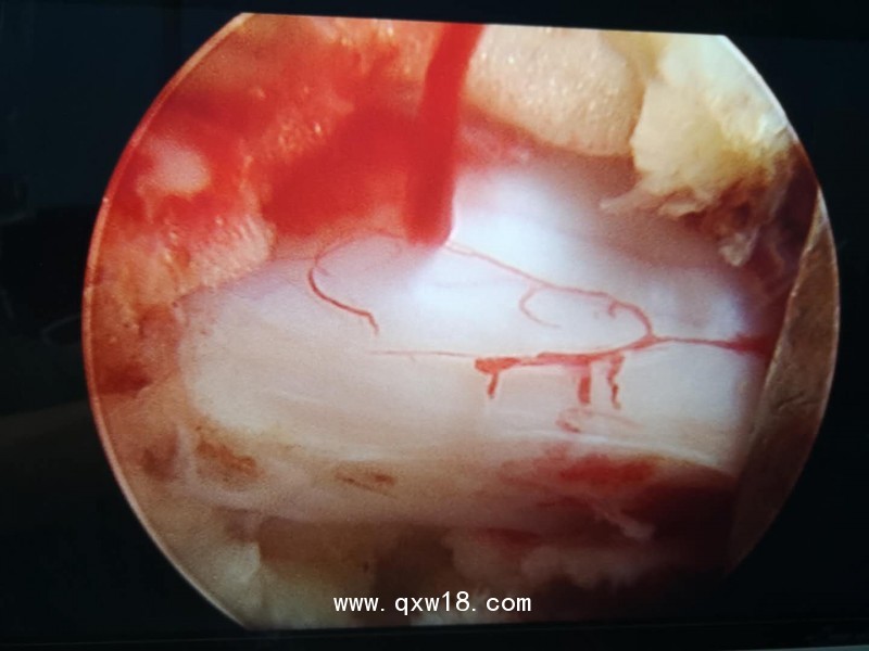 椎間孔鏡器械椎間孔鏡使用方法