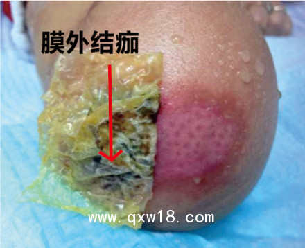 美國(guó)進(jìn)口歐密得Omiderm人工皮膜 傷口敷料