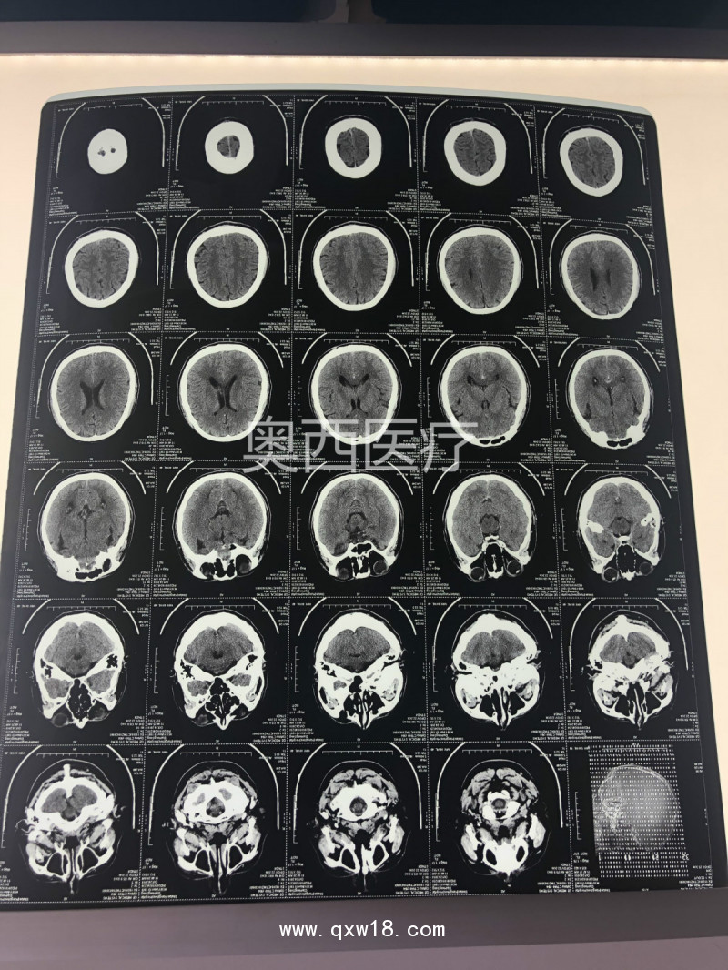 【奧格西】醫(yī)用干式進(jìn)口熱敏膠片（可提供自助取片機(jī)））