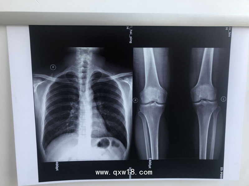 【奧格西】國(guó)產(chǎn)激光醫(yī)用膠片（三維彩超）