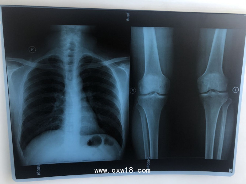 【奧格西】國(guó)產(chǎn)激光醫(yī)用膠片（三維彩超）