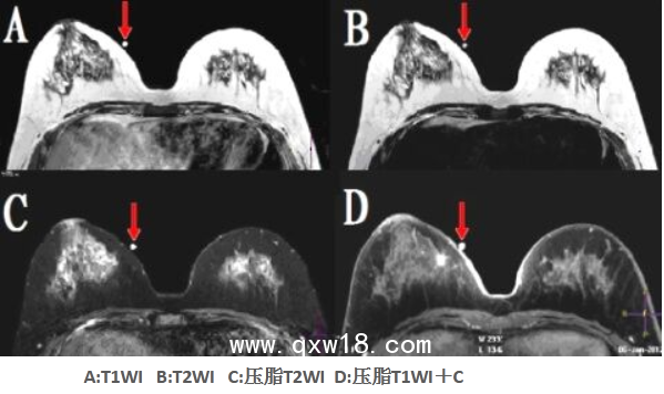 醫(yī)學(xué)圖像體外定位貼（MK⊙MR）