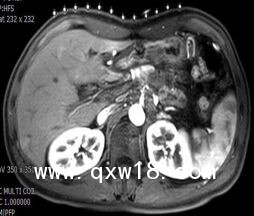 醫(yī)學(xué)圖像體外定位貼（MK#MR型，MR引導(dǎo)定位柵）