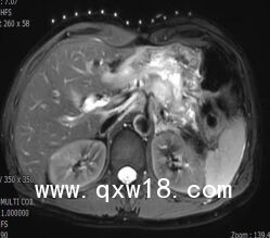 醫(yī)學(xué)圖像體外定位貼（MK#MR型，MR引導(dǎo)定位柵）