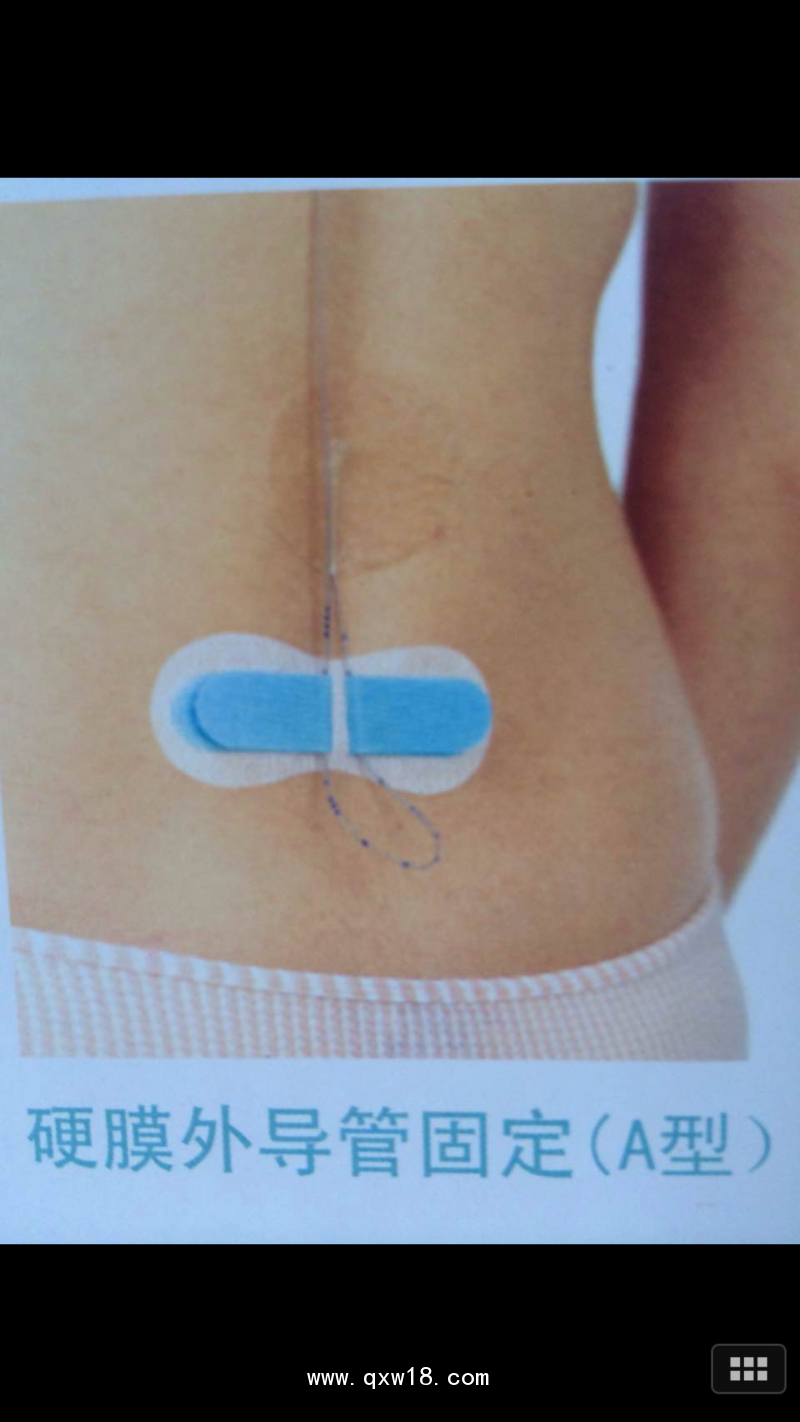 一次性使用無菌敷貼A型1號