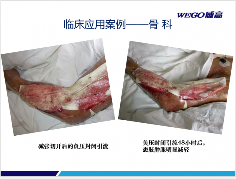 封閉創(chuàng)傷負(fù)壓引流套裝