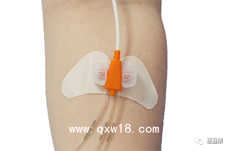 中心靜脈導(dǎo)管固定器-思樂扣