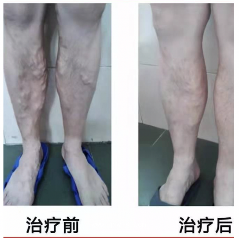 下肢靜脈曲張消融導管