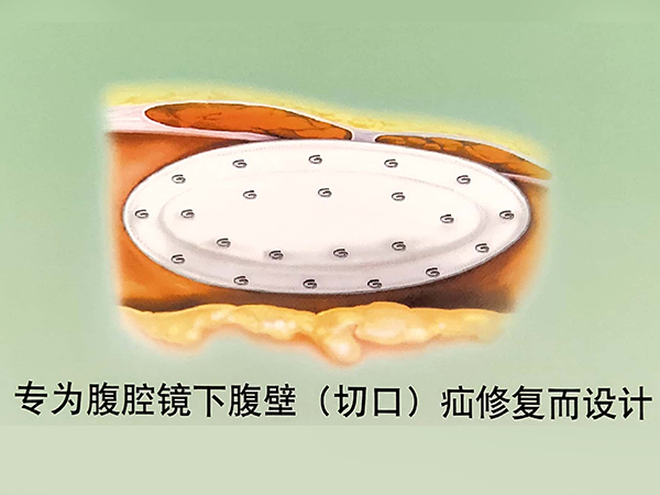 巴德切口疝補片