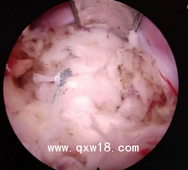 骨科高值耗材一次性纖維環(huán)縫合器