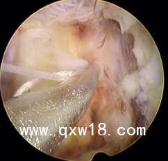 國產(chǎn)高值耗材非帶量纖維環(huán)縫合器生產(chǎn)廠家