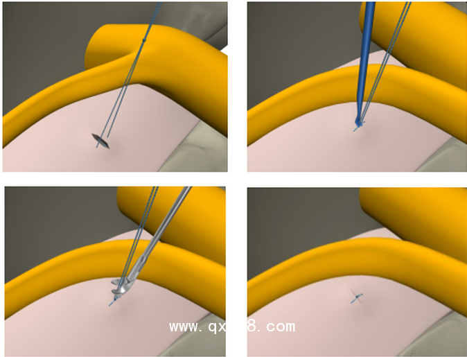椎間孔鏡手術(shù)高值耗材一次性纖維環(huán)縫合器