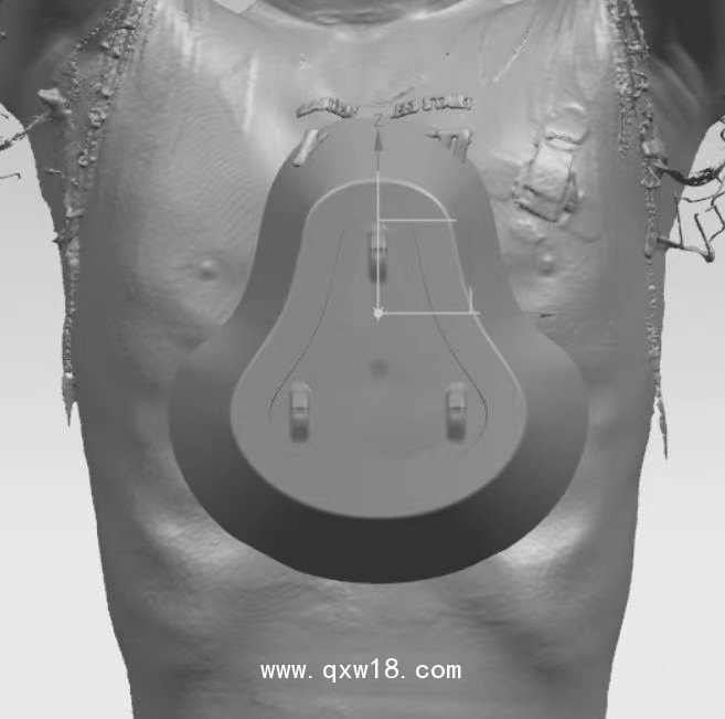 漏斗胸矯正器，負(fù)壓吸盤