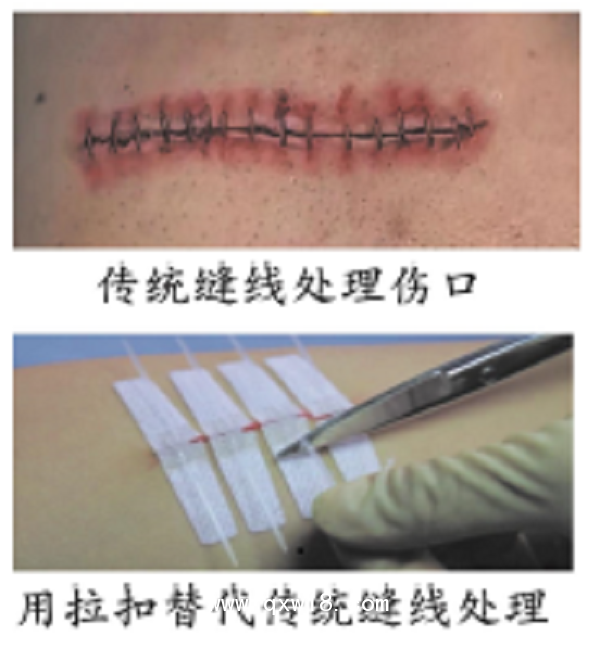 拉扣式皮膚縫合器