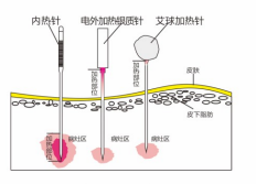 內(nèi)熱針治療儀設(shè)備