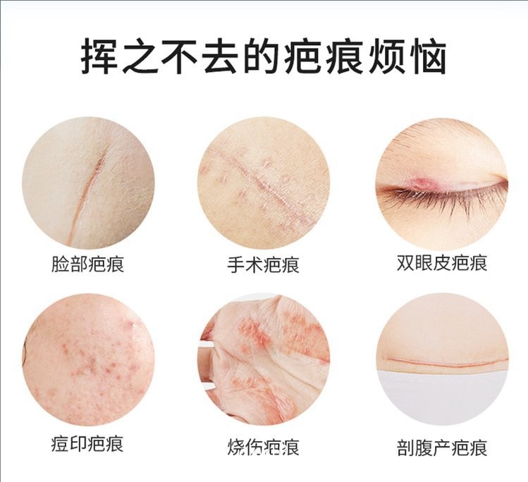 疤痕貼 疤痕凝膠生產廠家—全國招商承接代加工—可來樣加工按需定制