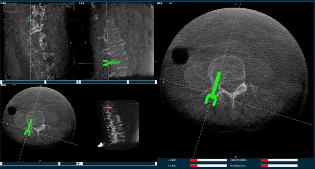 骨科手術(shù)機器人規(guī)劃圖像 骨科手術(shù)機器人規(guī)劃圖像