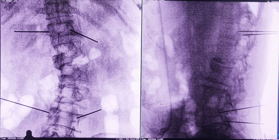 骨科手術(shù)機器人術(shù)后圖像 骨科手術(shù)機器人術(shù)后圖像